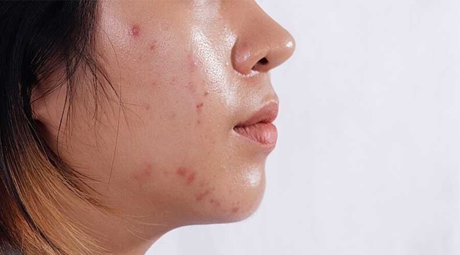 Da tiết nhiều dầu không hẳn do dư độ ẩm mà có thể là vì đang thiếu nước