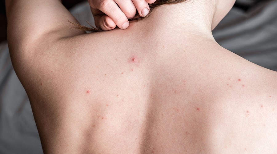 Mụn lưng gây mất thẩm mỹ và có thể xảy ra ở cả nam và nữ