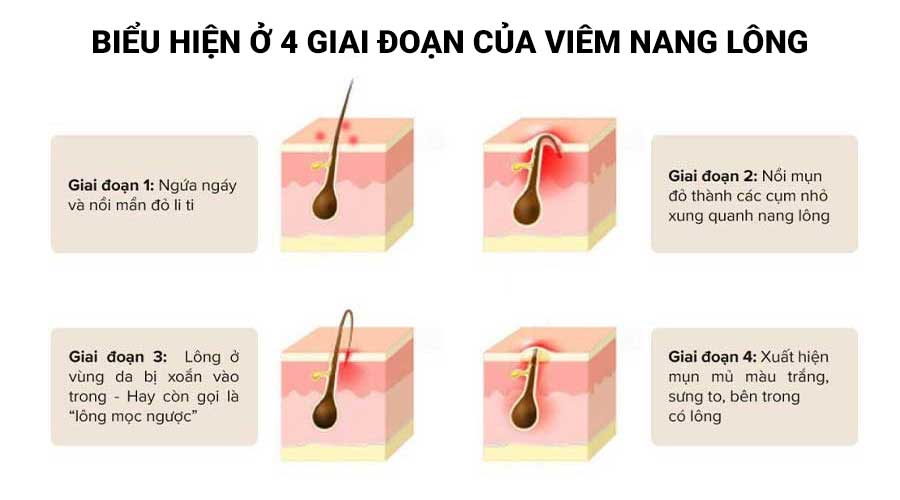 Biểu hiện thường gặp ở 4 giai đoạn của viêm nang lông