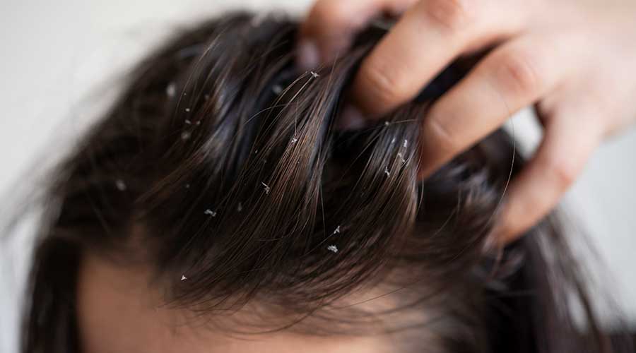 Không vệ sinh tóc và da đầu sạch sẽ cũng là nguyên nhân dẫn đến bị nấm