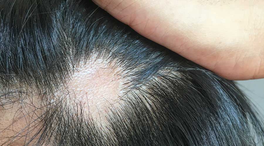 Nếu không được điều trị, nấm da đầu có thể gây rụng tóc dẫn đến hói mảng lớn