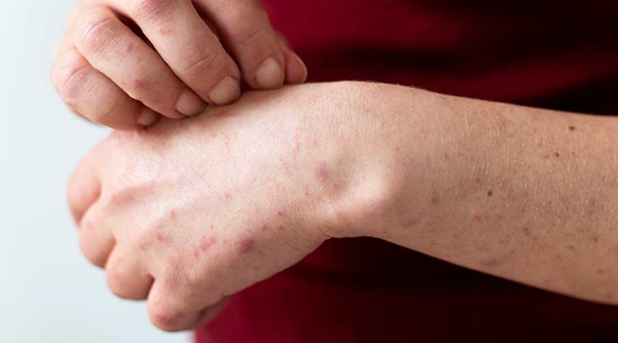Tác nhân từ bên ngoài chủ yếu là do các loại vi khuẩn, nấm gây ra viêm nang lông