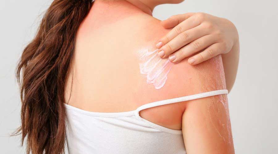 Tinh chất từ cây phỉ được ứng dụng nhiều trong mỹ phẩm giúp làm dịu và bảo vệ da