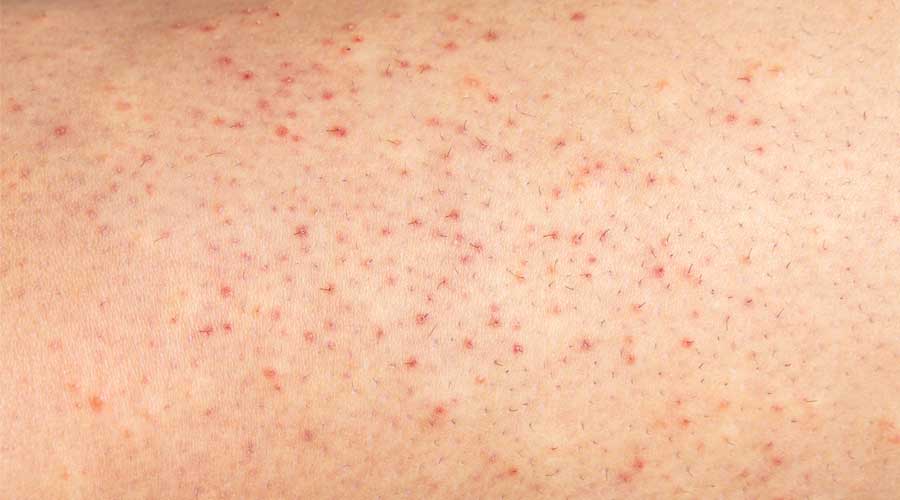 Viêm nang lông (viêm lỗ chân lông) là tình trạng nang lông bị viêm hoặc nhiễm trùng với biểu hiện là các nốt sần, mụn mủ gây ngứa